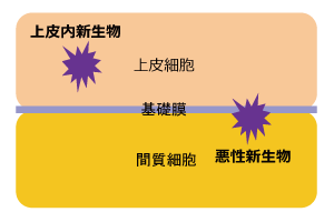 上皮内新生物と悪性新生物の違い　イラスト