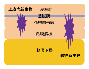 上皮内新生物と悪性新生物の違い　大腸の場合　イラスト